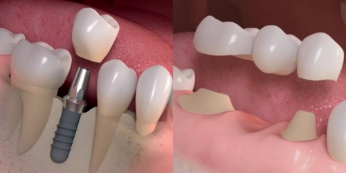 Kỹ thuật trồng răng giả cố định cải thiện khả năng ăn nhai rất nhiều