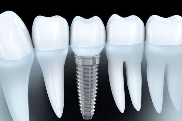 trồng răng cố định