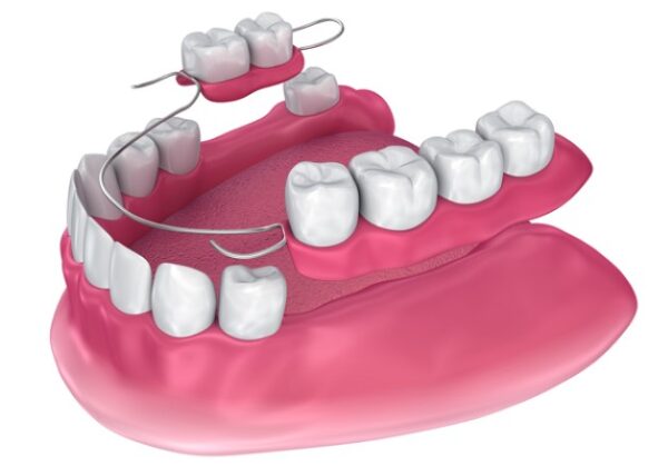 Hàm giả tháo lắp là phương pháp trồng răng truyền thống không đòi hỏi kỹ thuật cao