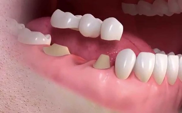 Trồng răng hàm dưới bằng phương pháp cầu răng sứ