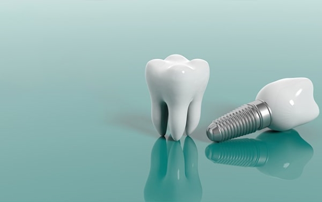 Trồng răng implant giá bao nhiêu