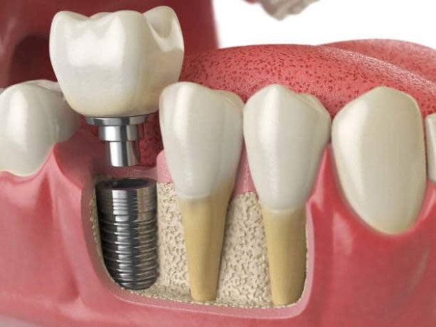 trổng răng Implant