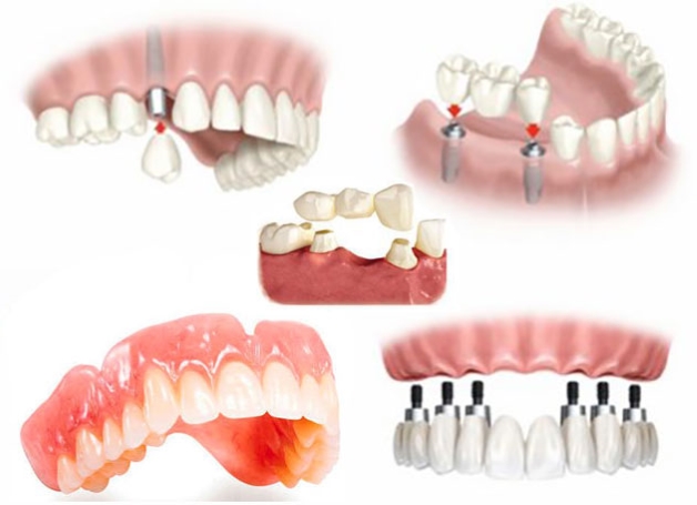 Trồng răng sứ bao nhiêu tiền tùy thuộc vào phương pháp thực hiện