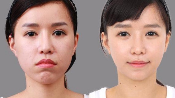 niềng răng hô