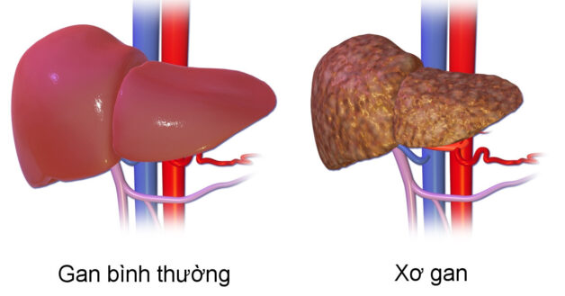 Nếu không được điều trị phù hợp, từ gan nhiễm mỡ có thể biến chứng thành xơ gan rất nguy hiểm