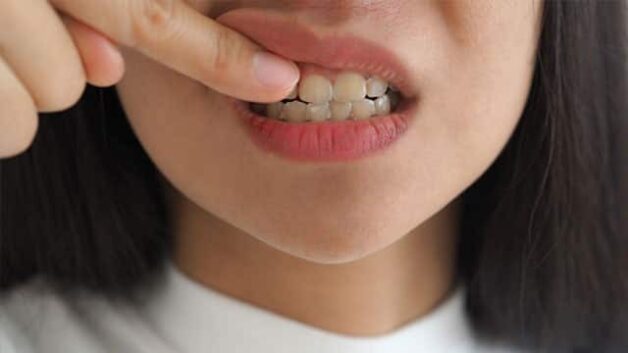 tự lấy cao răng tại nhà
