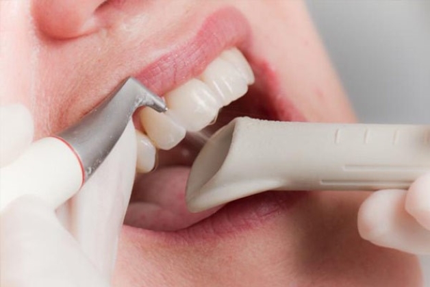 Hiệu quả tự lấy vôi răng thế nào?