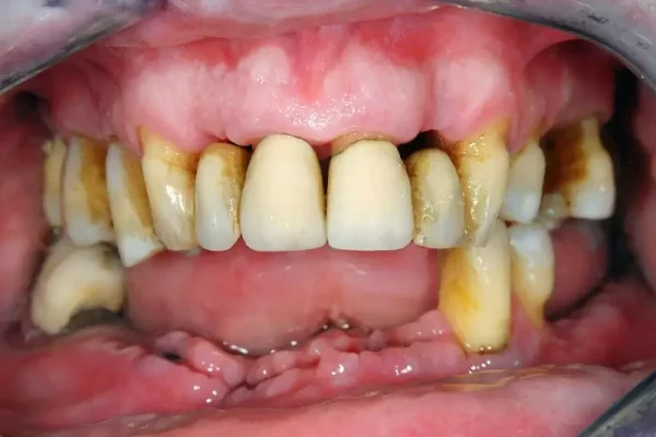 tụt lợi răng lung lay
