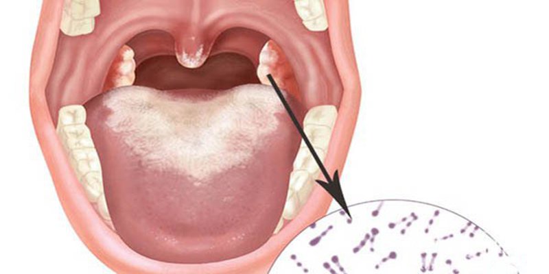 vacxin bạch hầu uốn ván