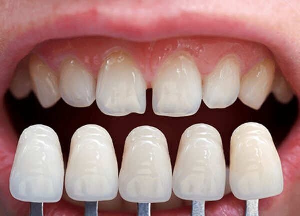 vật liệu dán sứ veneer từ gì