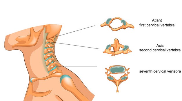 cách trị gai đốt sống cổ