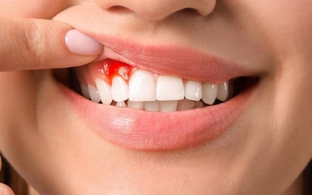 viêm chân răng gây hôi miệng