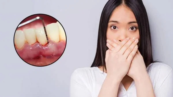 viêm chân răng hôi miệng