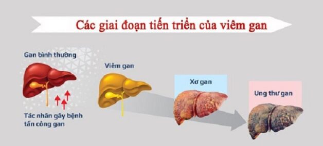 viêm gan B chuyển sang ung thư gan