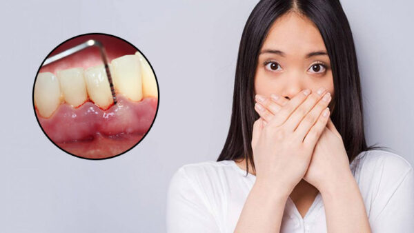 viêm lợi có mùi hôi thường xuất hiện phổ biến ở mọi lứa tuổi