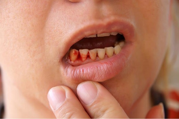 Hình ảnh viêm lợi hôi miệng chảy máu chân răng