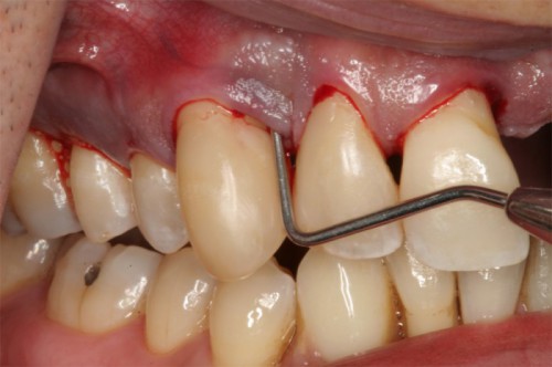 Bệnh cần được điều trị tránh để xảy ra những biến chứng nặng nề