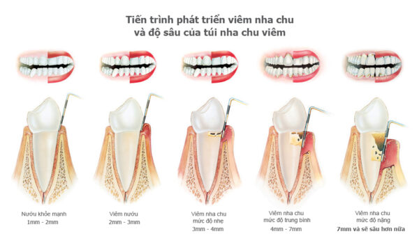 Sự khác nhau về triệu chứng viêm nướu và bệnh nha chu
