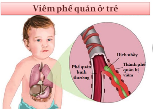 Trẻ em cũng có nguy cơ mắc viêm phế quản mãn tính-1