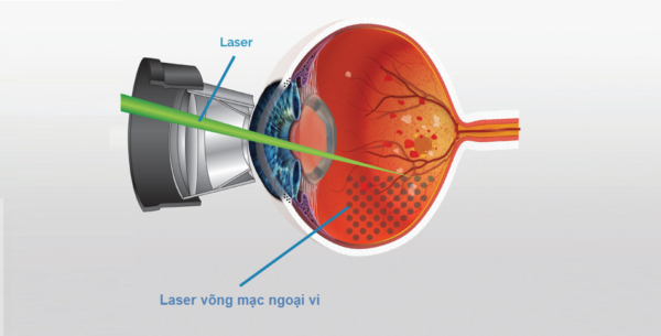 Laser quang đông là một trong những phương pháp phổ biến điều trị bệnh võng mạc trẻ sơ sinh