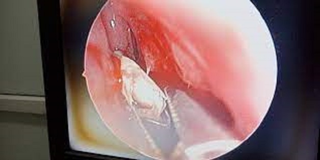 Hình ảnh thực tế dị vật trong mũi