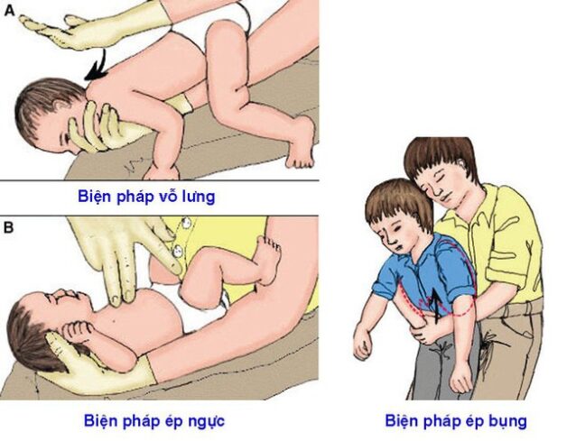 xử lý người bị hóc dị vật đường thở đúng cách