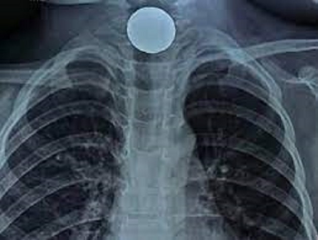 Cần xử trí hóc dị vật thực quản