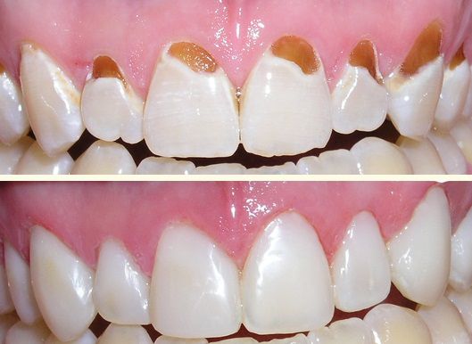 Ý nghĩa hàn răng thẩm mỹ