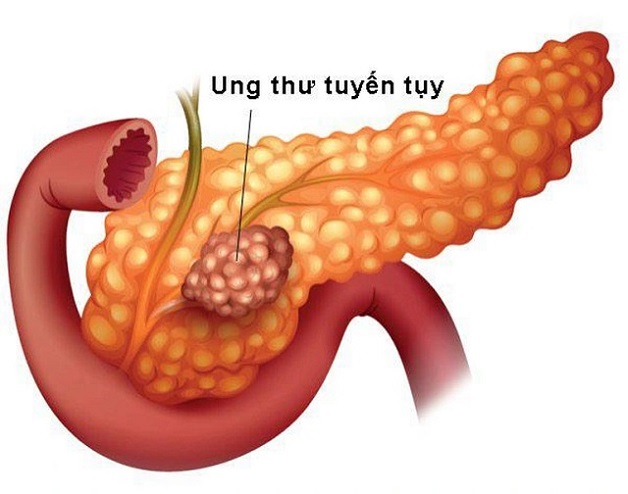 ung thư tụy