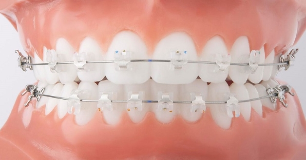 Phương pháp niềng răng mắc cài tự buộc