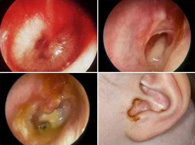 Vi khuẩn, virus là nguyên nhân phổ biến nhất gây nên viêm tai giữa ở trẻ em
