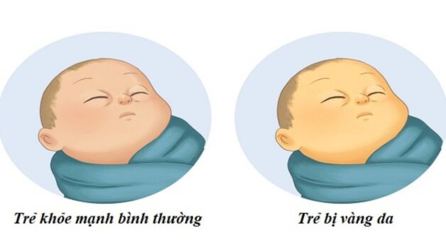 Trẻ sơ sinh khi mắc bệnh có thể bị vàng da