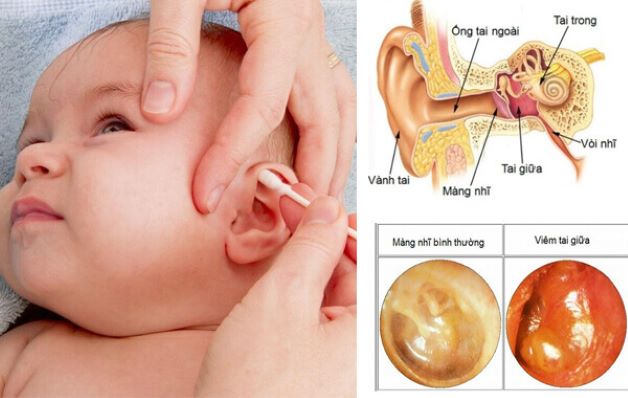 Bé mắc bệnh viêm tai giữa cần được vệ sinh tai đúng cách mỗi ngày