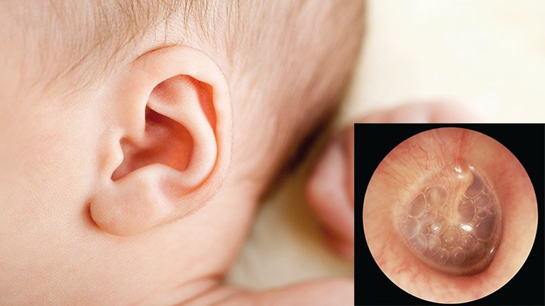 bị viêm tai giữa có tiêm phế cầu được không