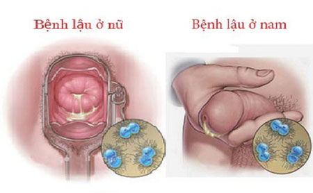 Bệnh lậu là bệnh phổ biến, rất dễ lây nhiễm khi bạn quan hệ tình dục không an toàn