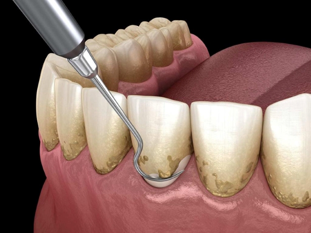 Tiêu chí chọn nha khoa lấy cao răng siêu âm ở Hà Nội