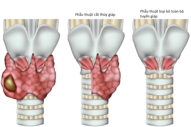 Phẫu thuật cắt tuyến giáp trong điều trị ung thư