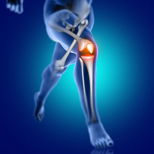 Tổng quan thoái hóa khớp gối.