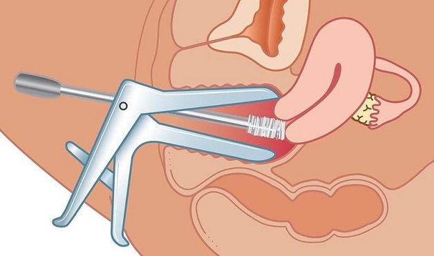 tầm soát ung thư cổ tử cung