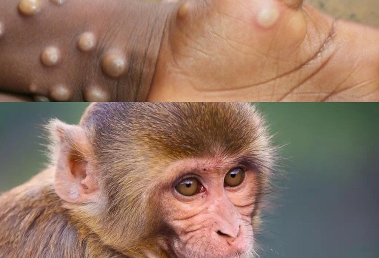 đậu mùa khỉ có vaccine không