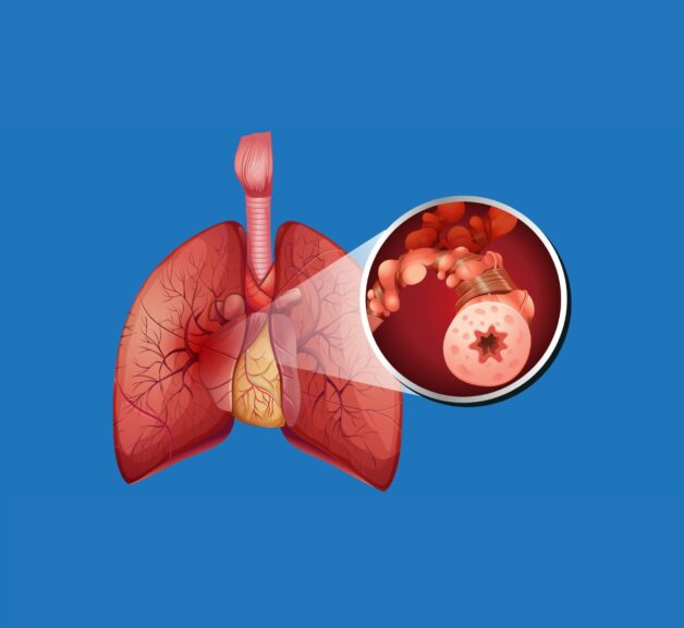 Bệnh được đặc trưng bởi các triệu chứng hô hấp kéo dài.