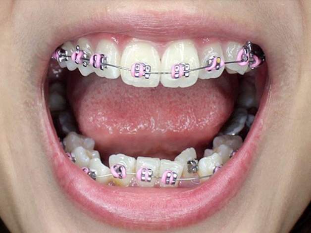 Các giai đoạn niềng răng
