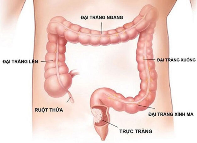 tiên lượng sống của bệnh nhân ung thư đại tràng