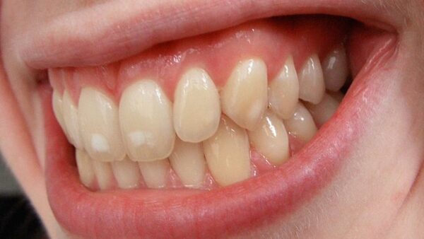 Mảng bám trắng trên răng là gì?