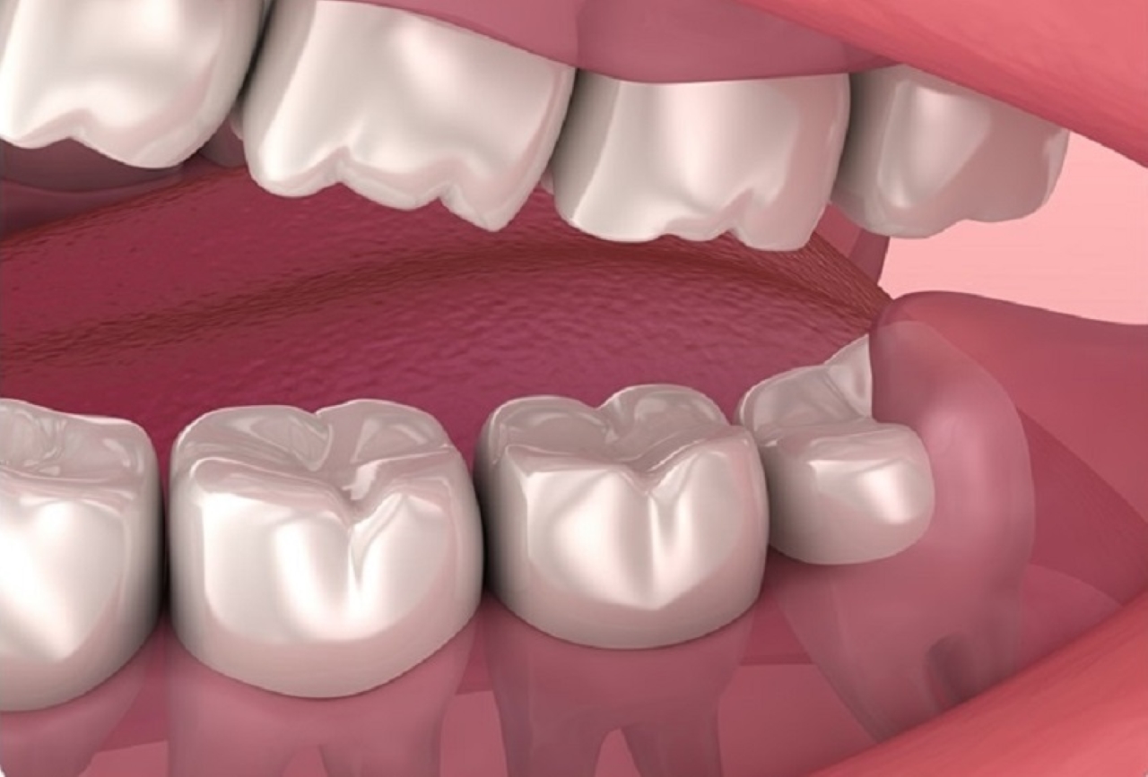 Thực hiện nhổ 2 răng kh&ocirc;n c&ugrave;ng l&uacute;c v&agrave; lưu &yacute;