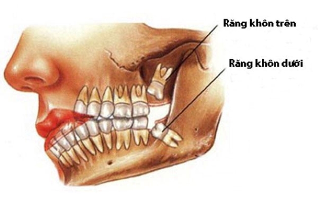 Vị trí răng khôn
