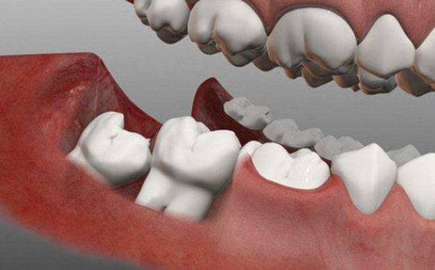Thực hiện nhổ răng khôn nguy hiểm không và lưu ý