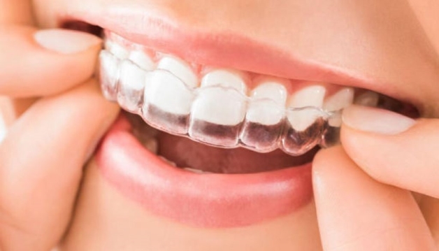 Niềng răng trong suốt