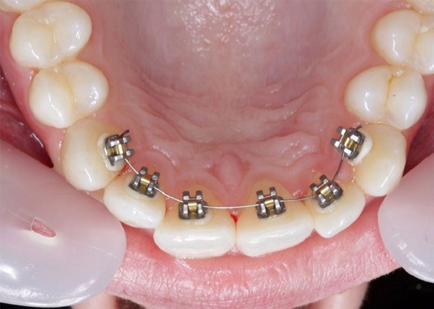 Niềng răng mắc cài ở mặt lưỡi
