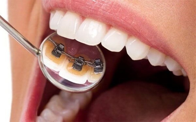 Thực hiện niềng răng mặt lưỡi